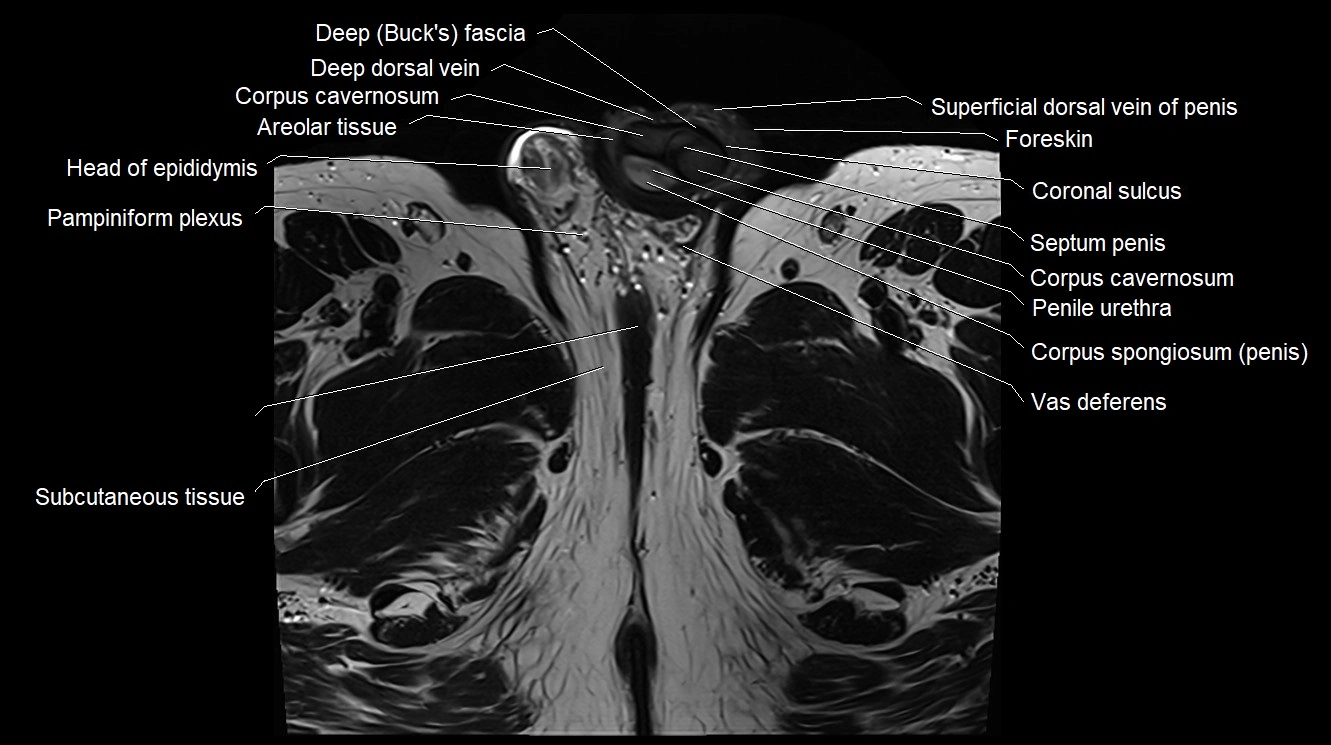 MRI 3T scrotum and penis axial cross sectional anatomy image 25.webp